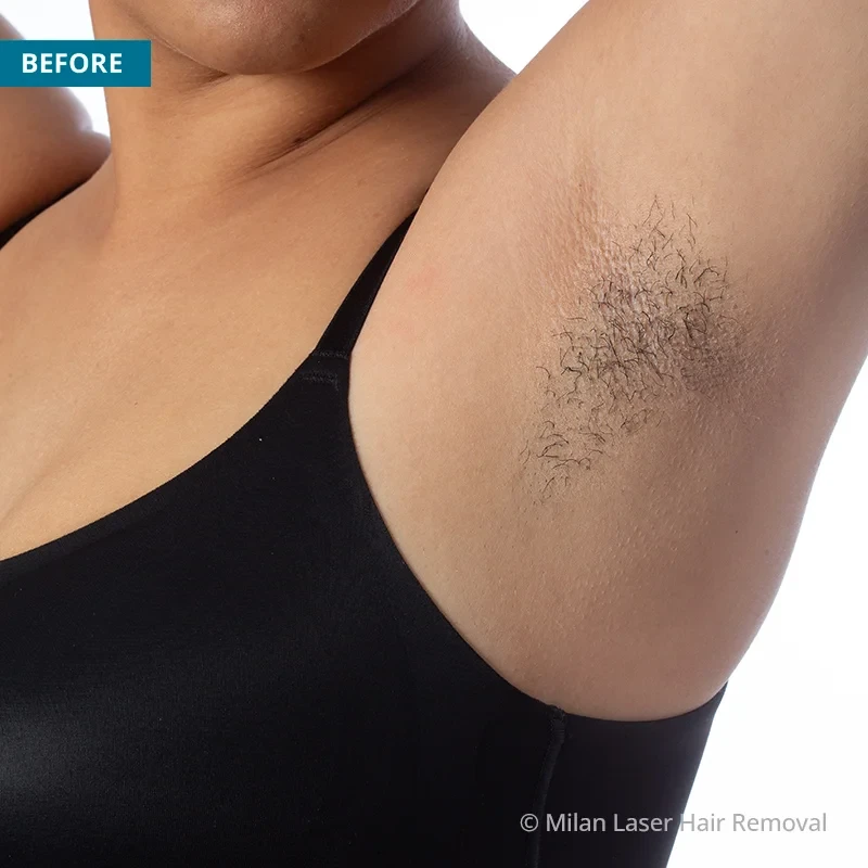 Before and after preview for underarm